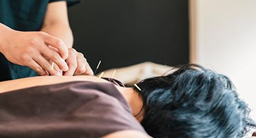 Akupunktur nedir? 
